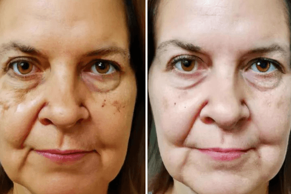 Antes e Depois