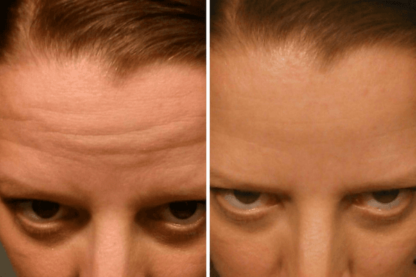 Antes e Depois