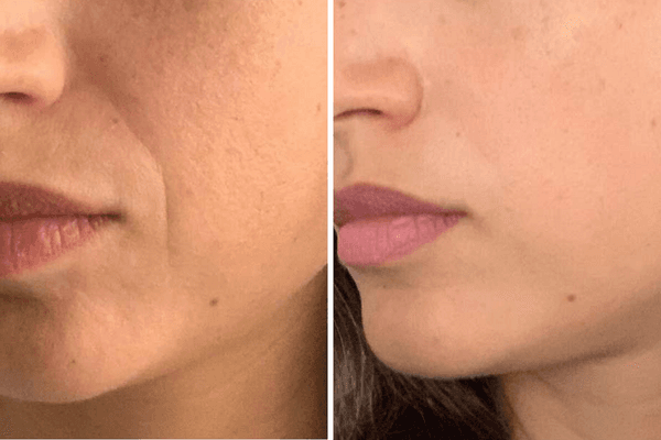 Antes e Depois