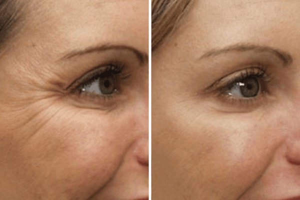 Antes e Depois