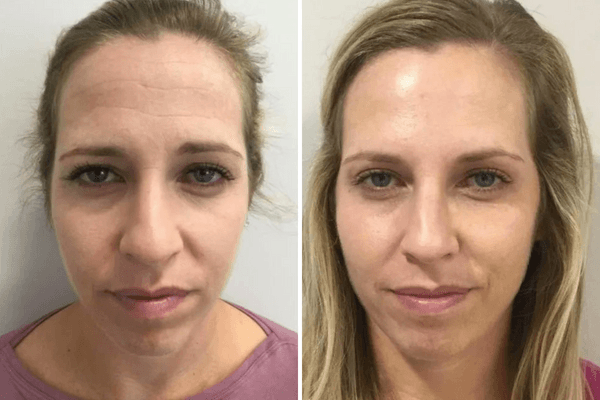Antes e Depois