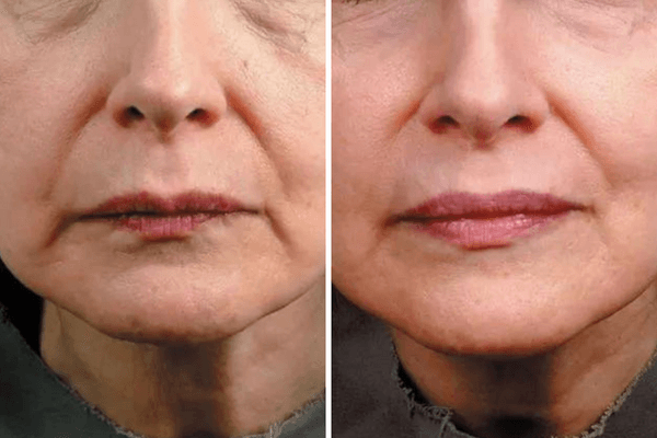 Antes e Depois