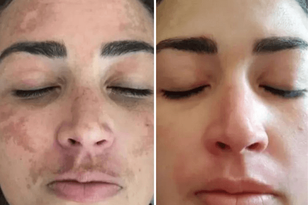 Antes e Depois