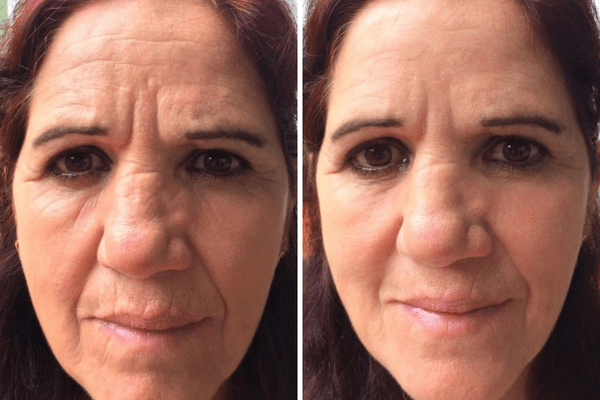 Antes e Depois
