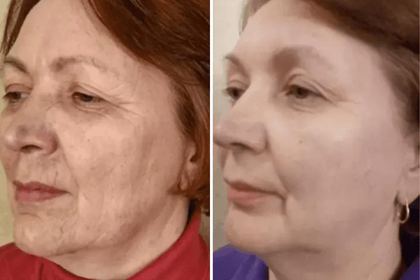 Antes e Depois