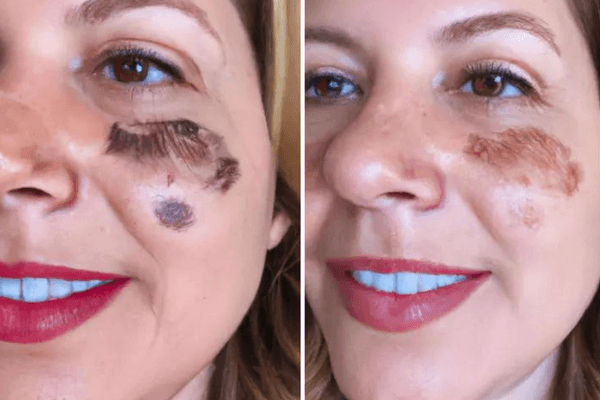 Antes e Depois